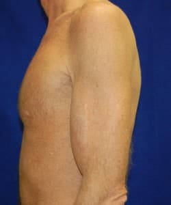 Bicep Augmentation