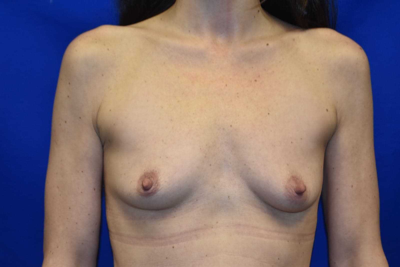 Case 2 — 425cc - Before