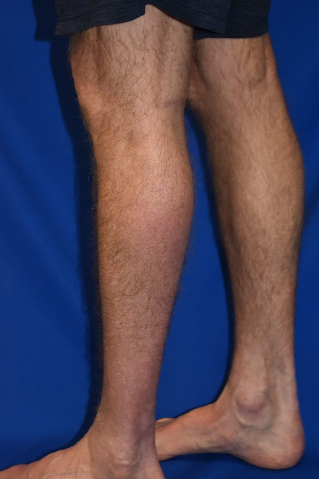 Calf Augmentation