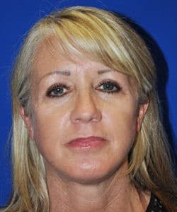 Chin Augmentation