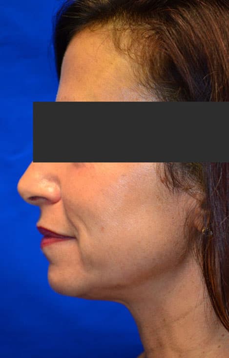 Kybella