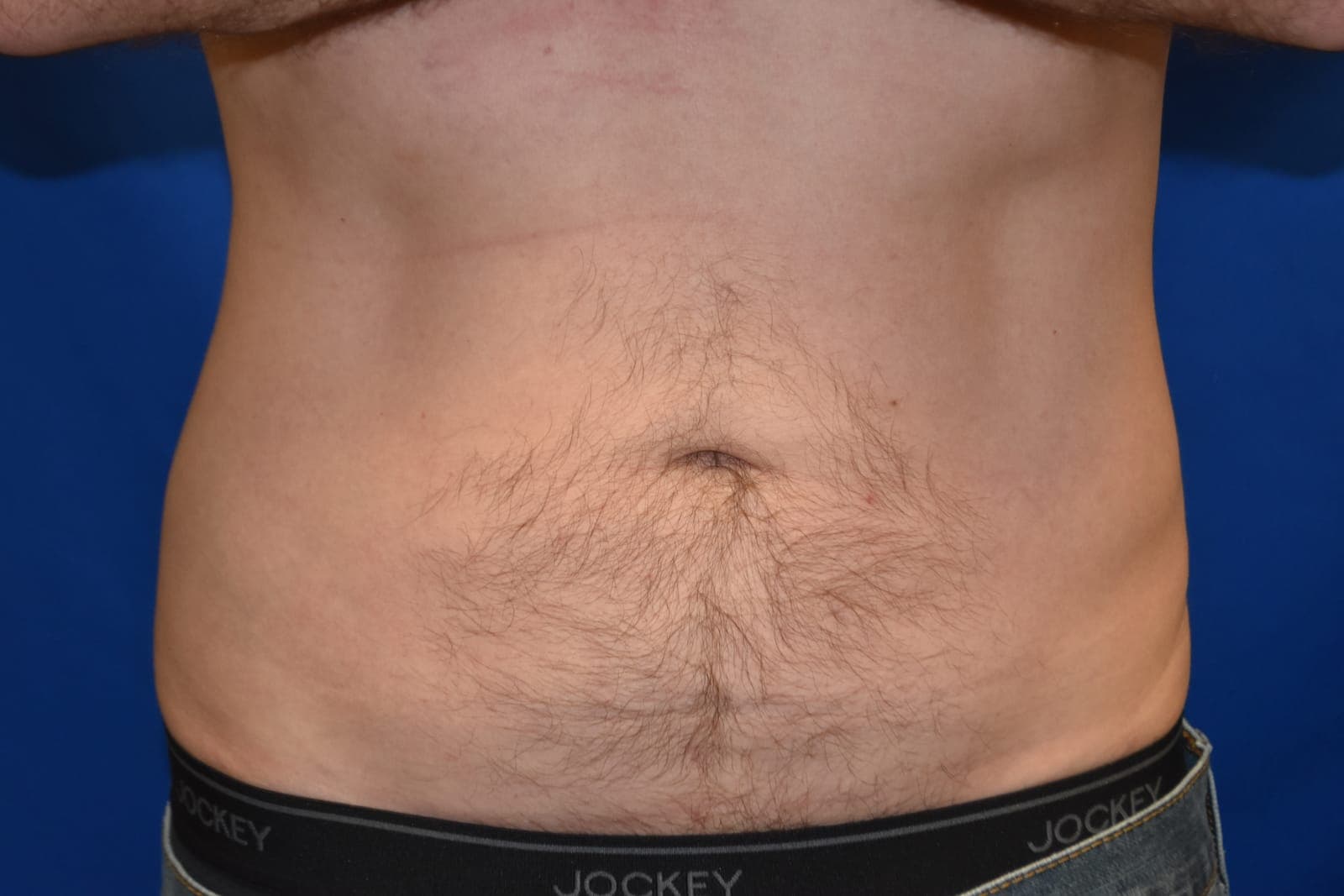 Case 2 — Abdomen - After