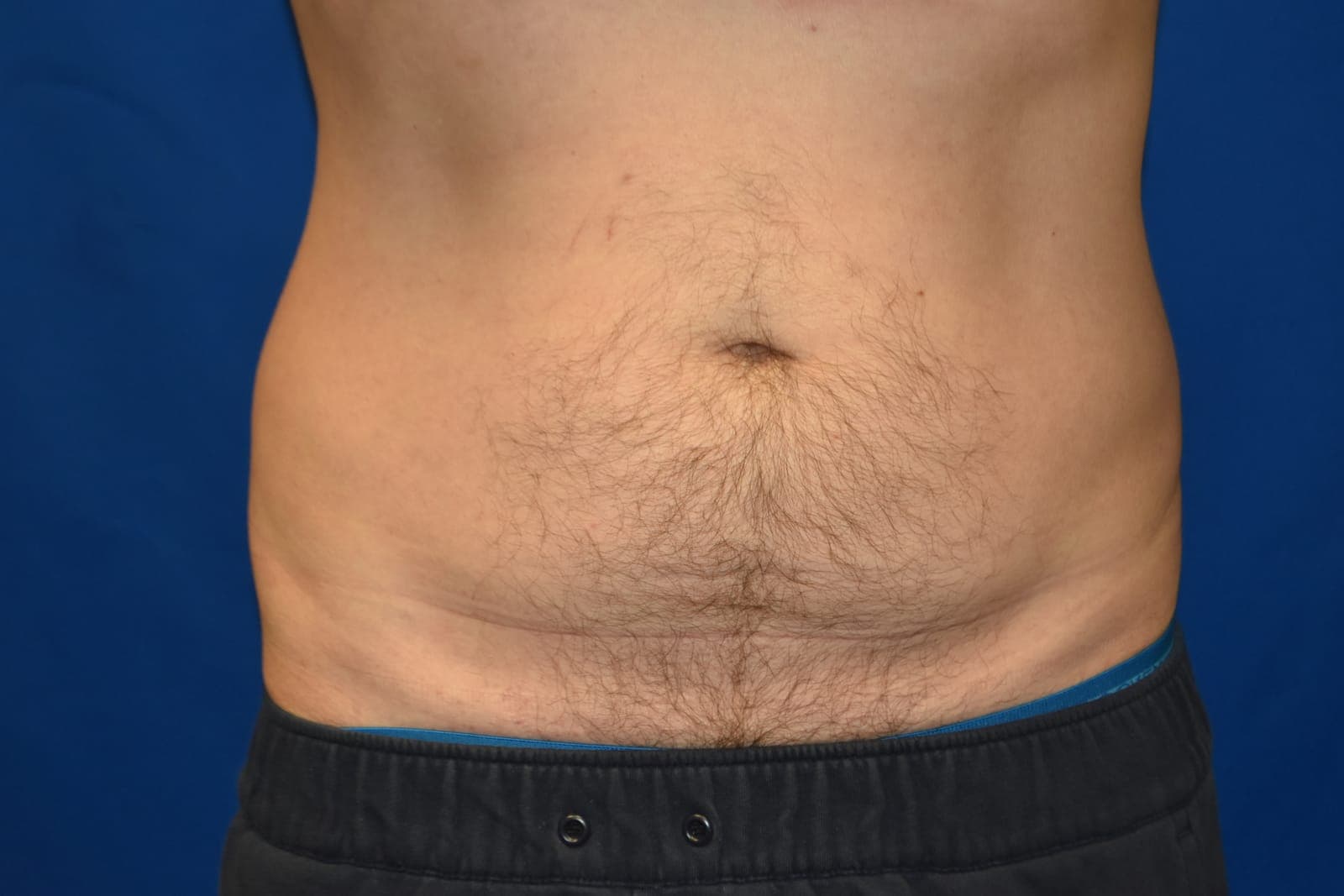Case 2 — Abdomen - Before