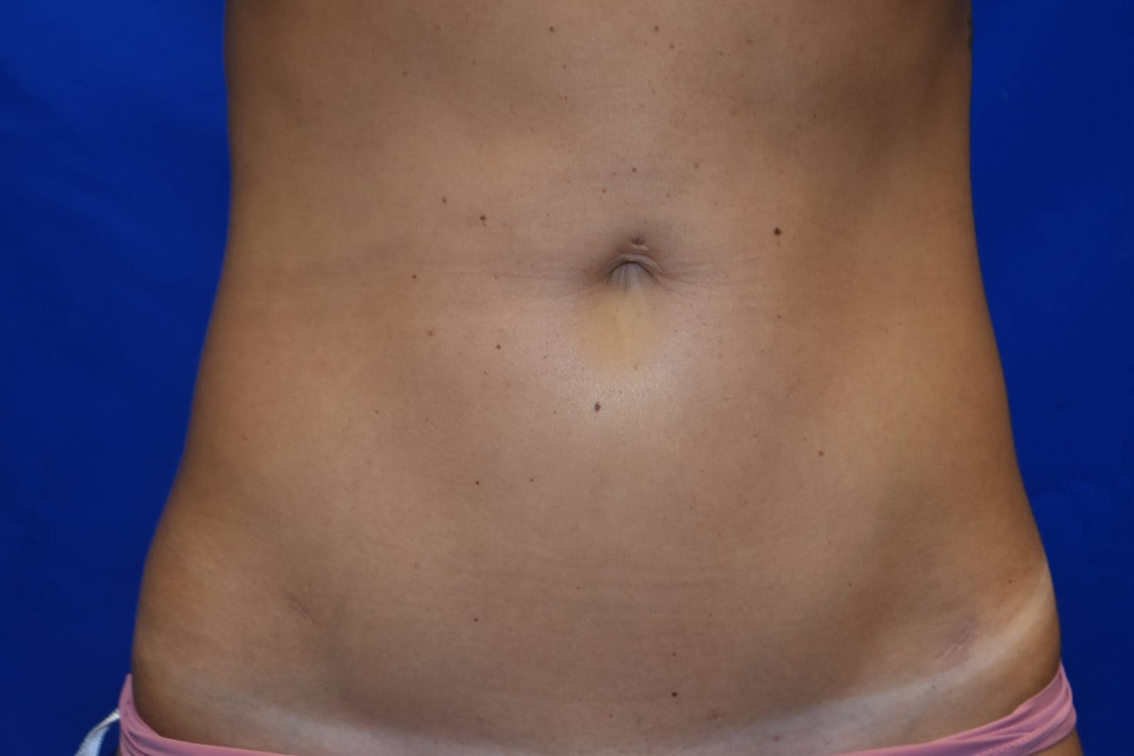 Case 3 — Abdomen - After
