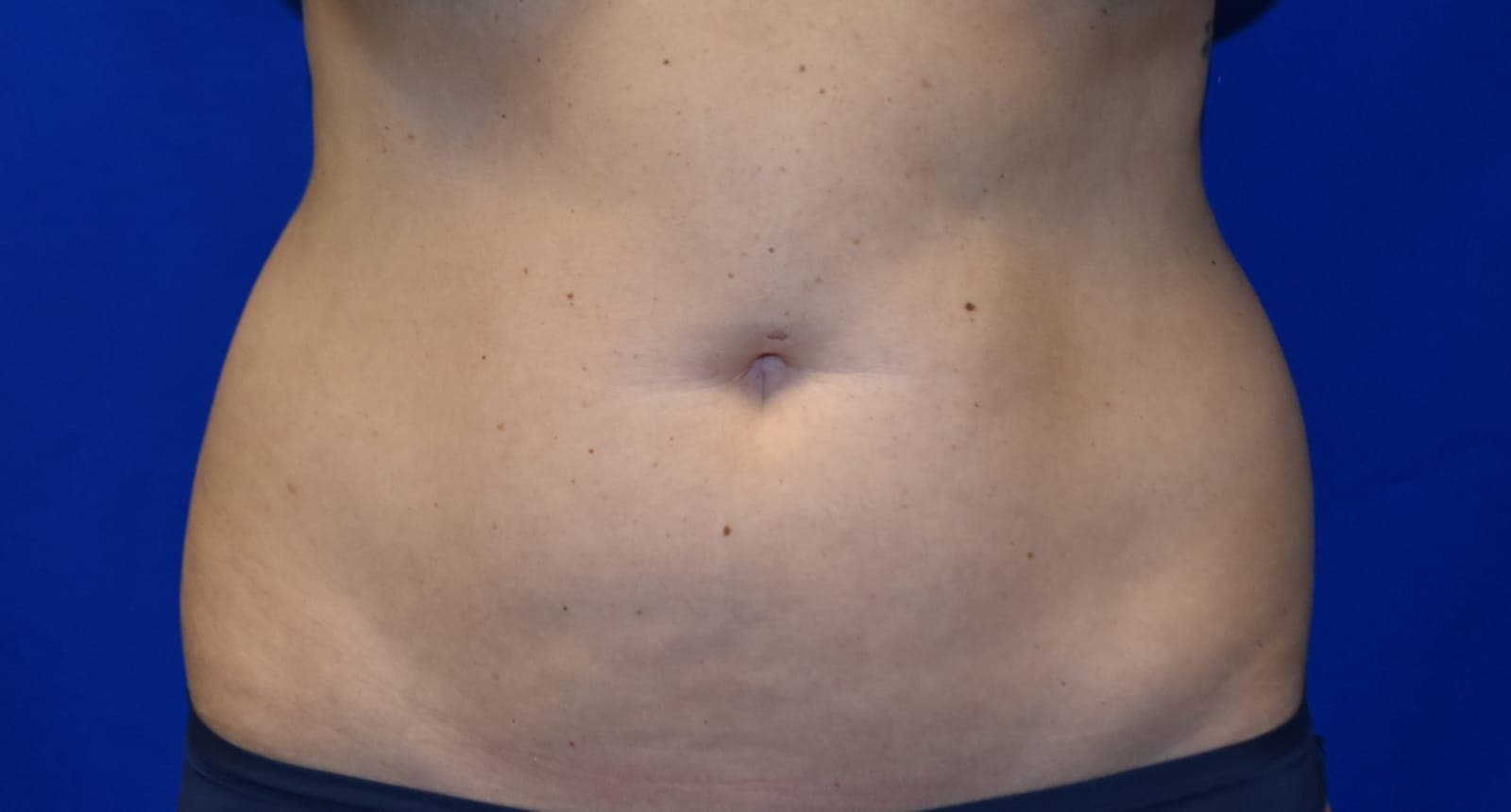 Case 3 — Abdomen - Before