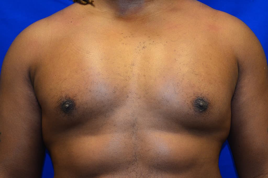 Pectoral Augmentation