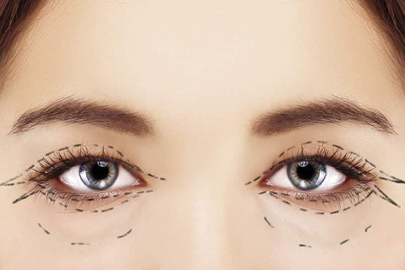 Eyelid Surgery