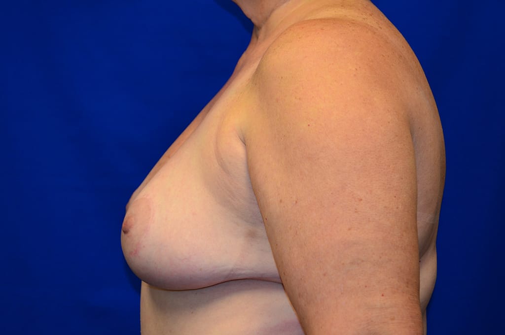 Case 1 Mommy Makeover - Left profile
