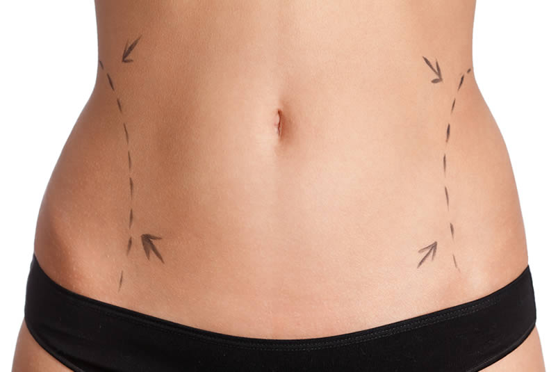 The Procedure For An Outpatient Liposuction Procedure Is