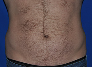 Before-front-abdomen