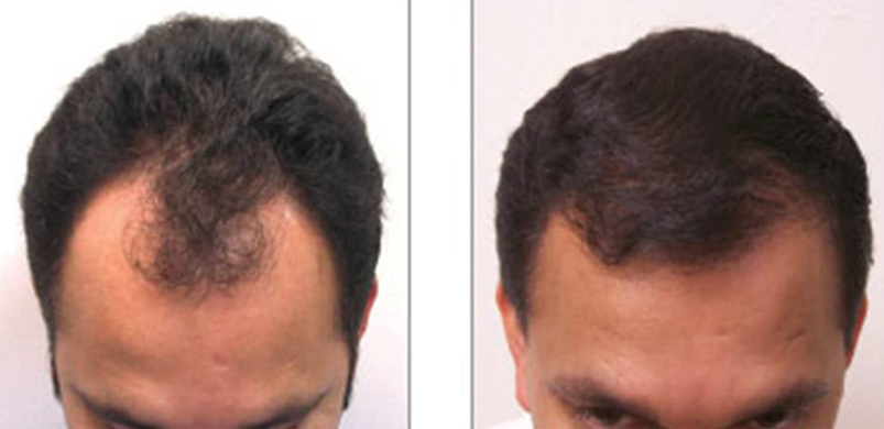 Hair Transplant Turkey - £1250 - Free UK Consultation