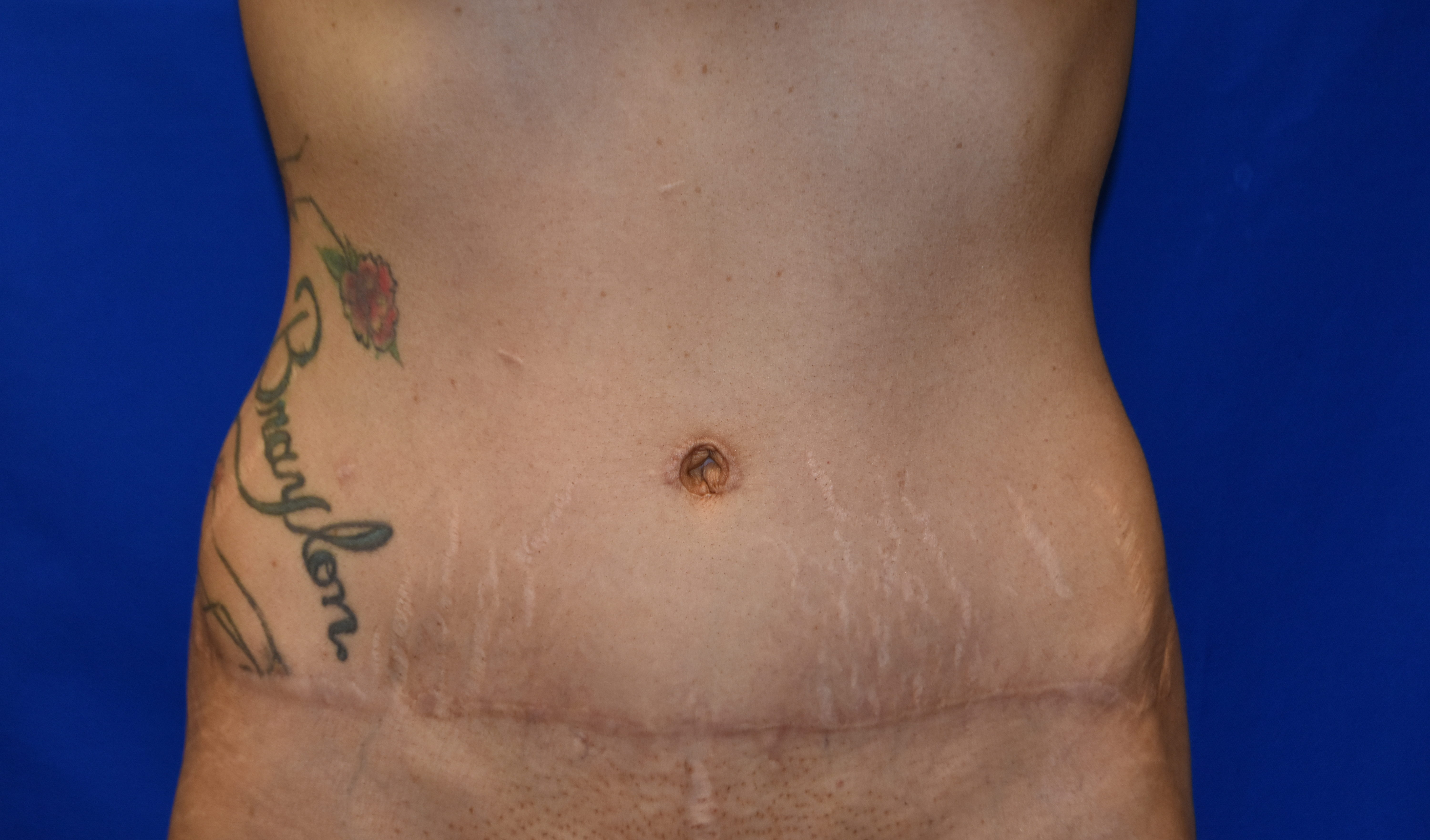 Abdominoplasty (Tummy Tuck), Cincinnati & Springboro