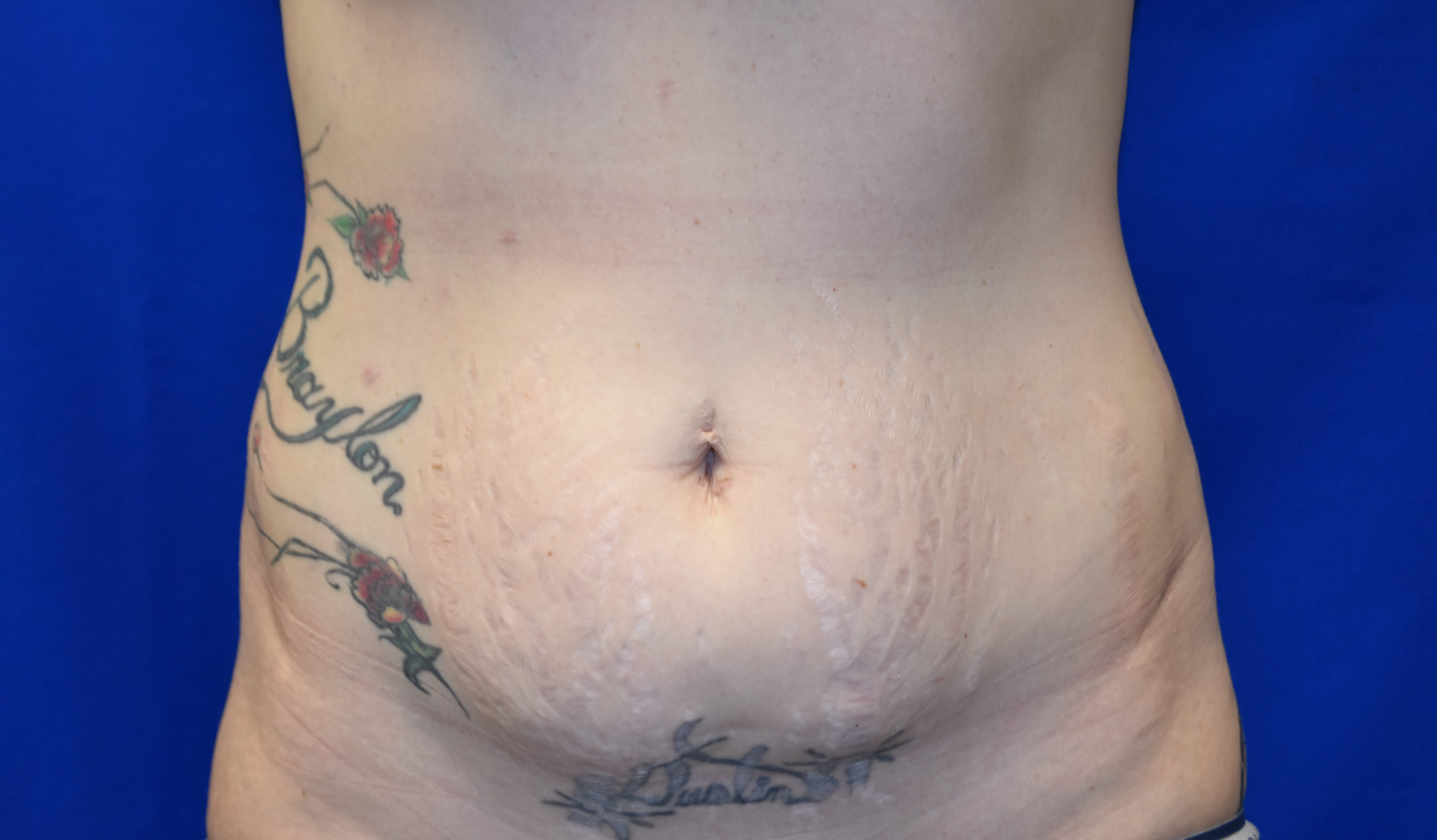 Before-abdominoplasty front