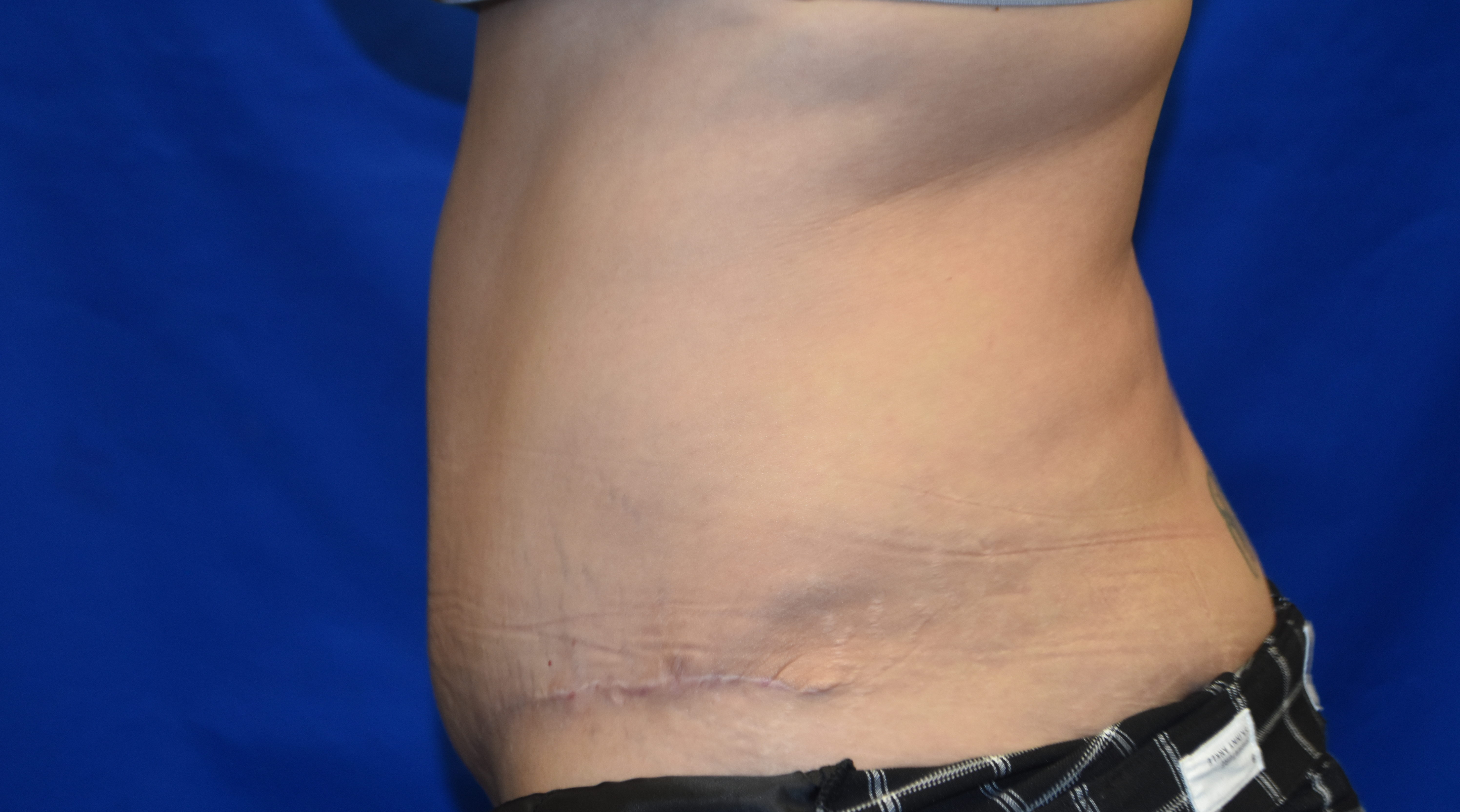 After-abdominoplasty side