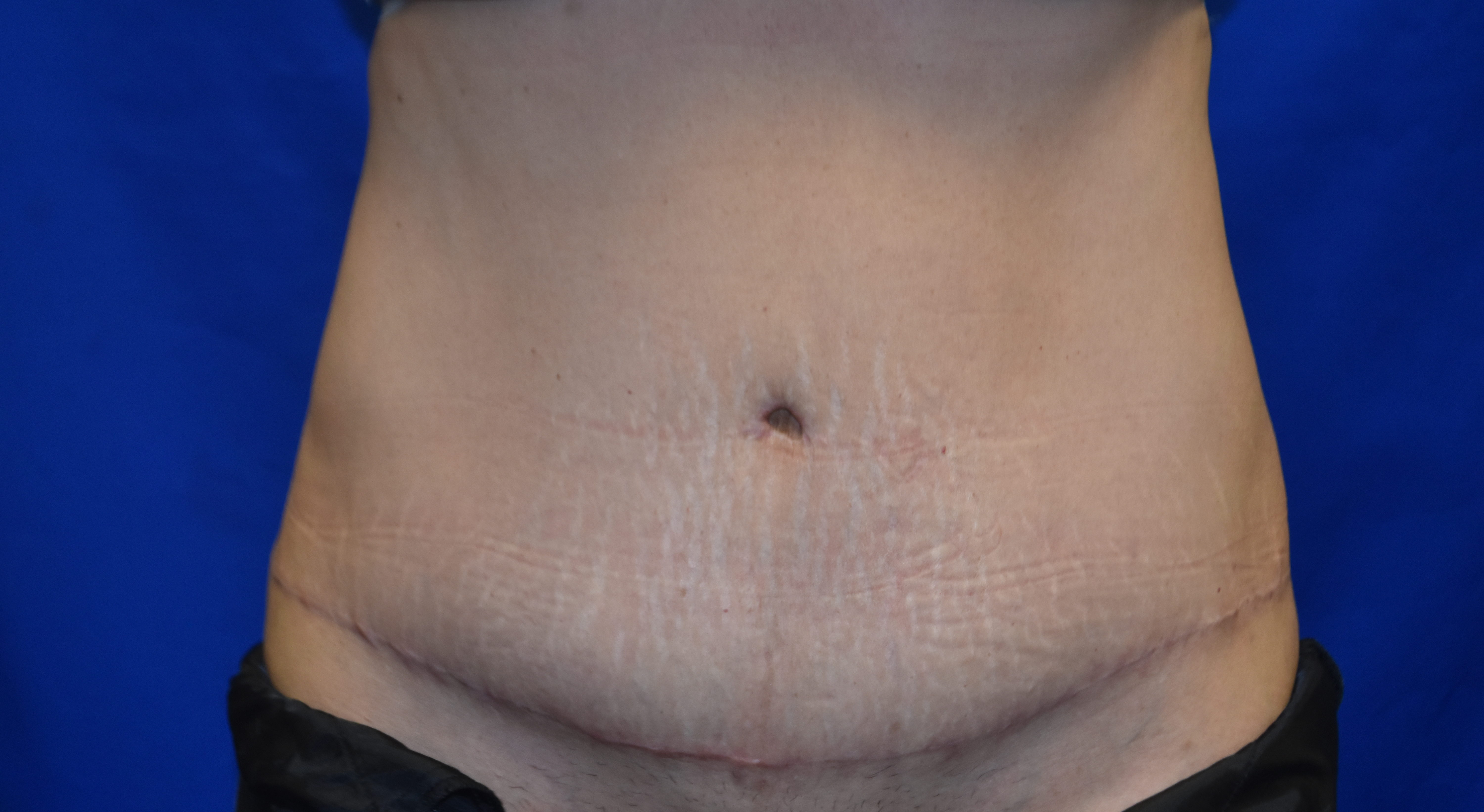 After-abdominoplasty front