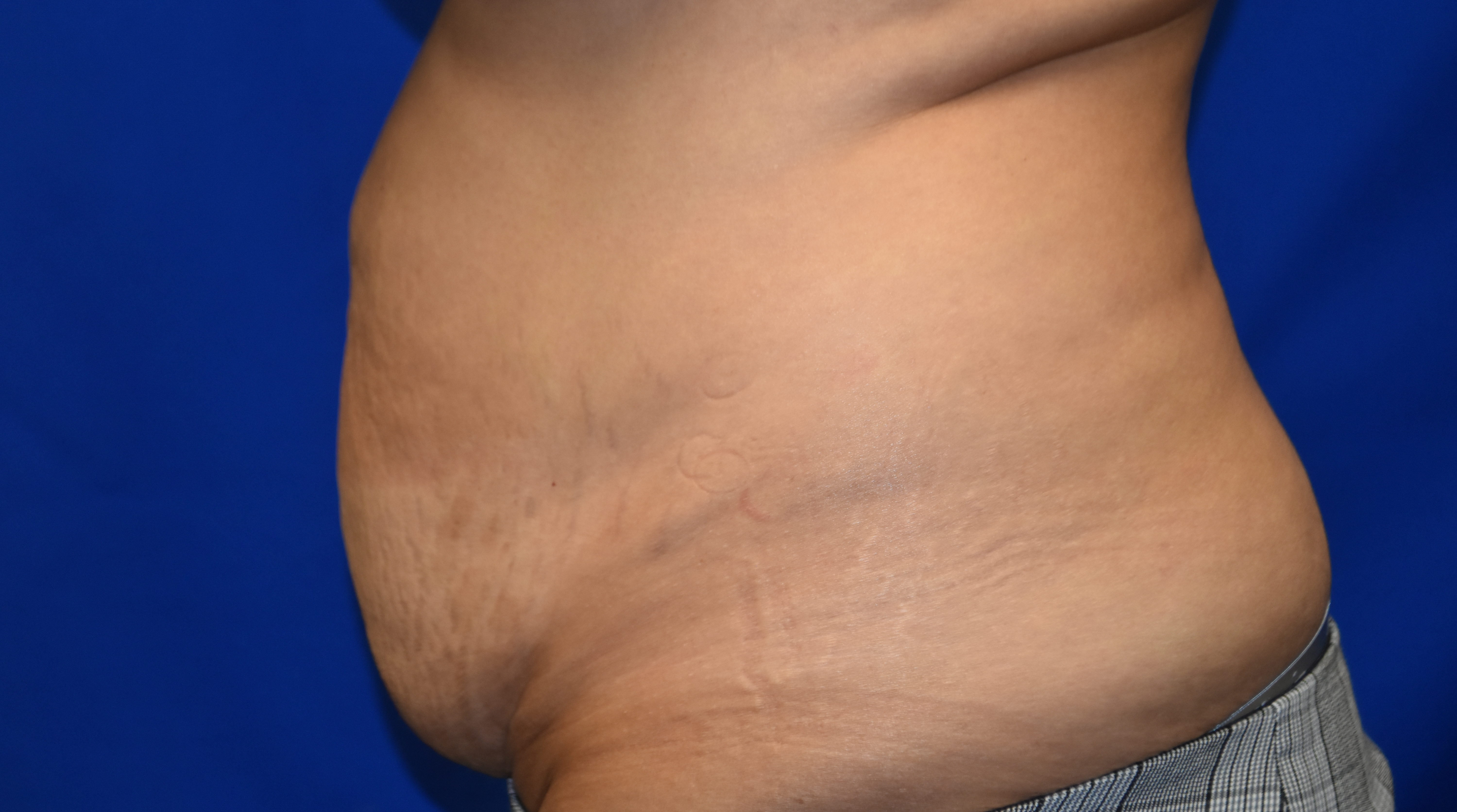 Before-abdominoplasty side