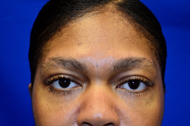 After-eyelid tuck front
