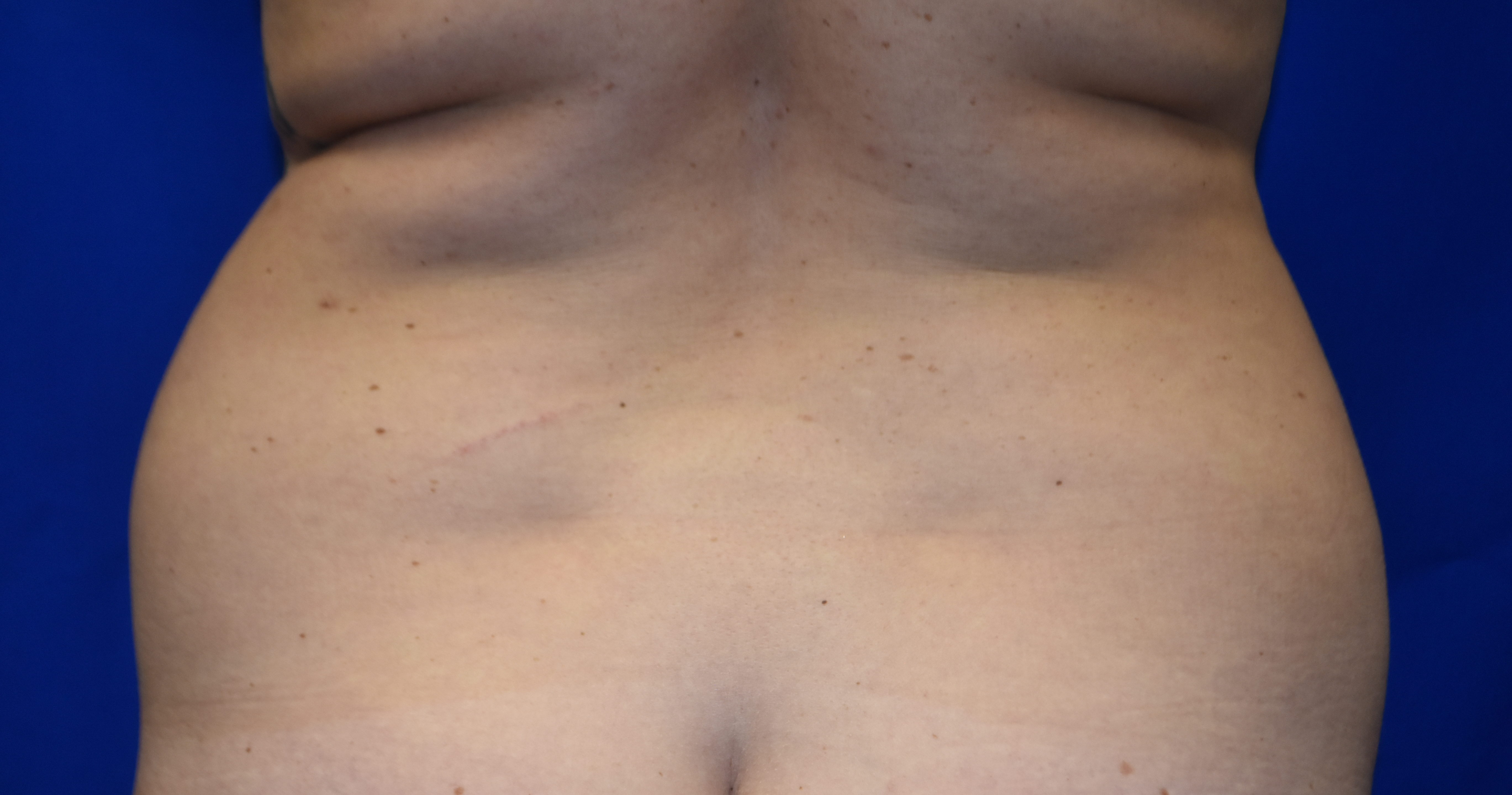 Before-liposuctionBACK01