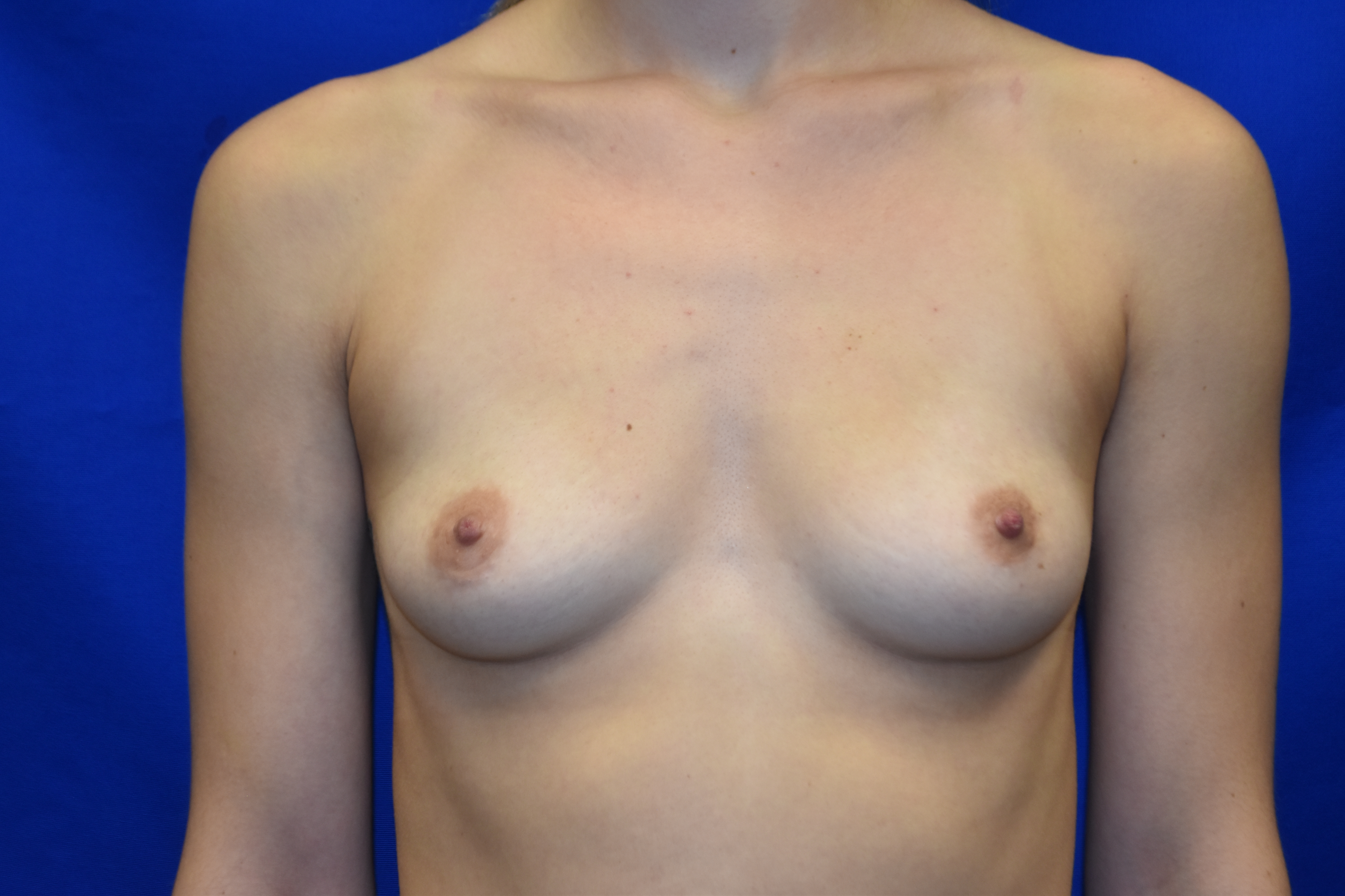 Before-breast aug front