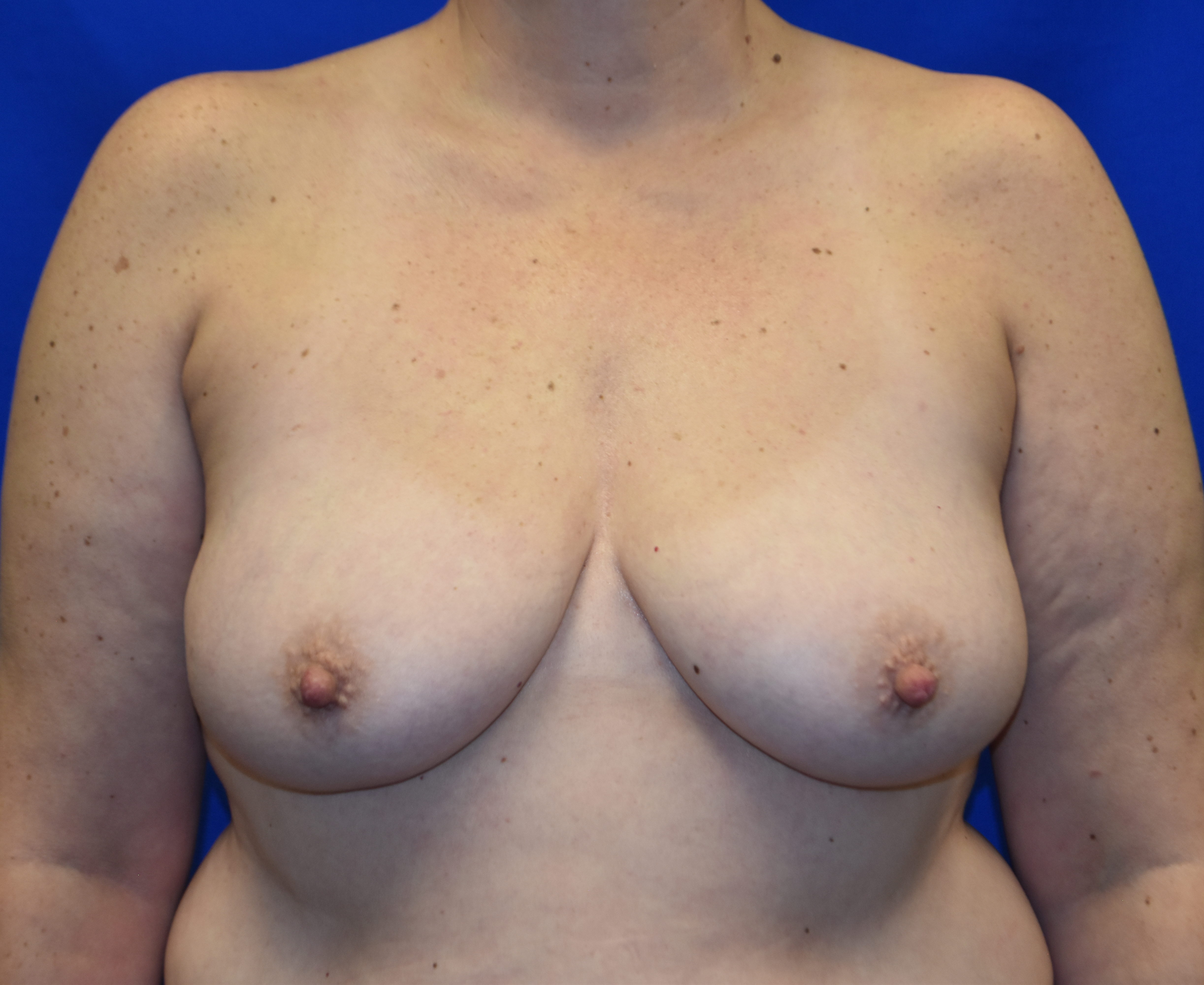 After-breast Reduction Front