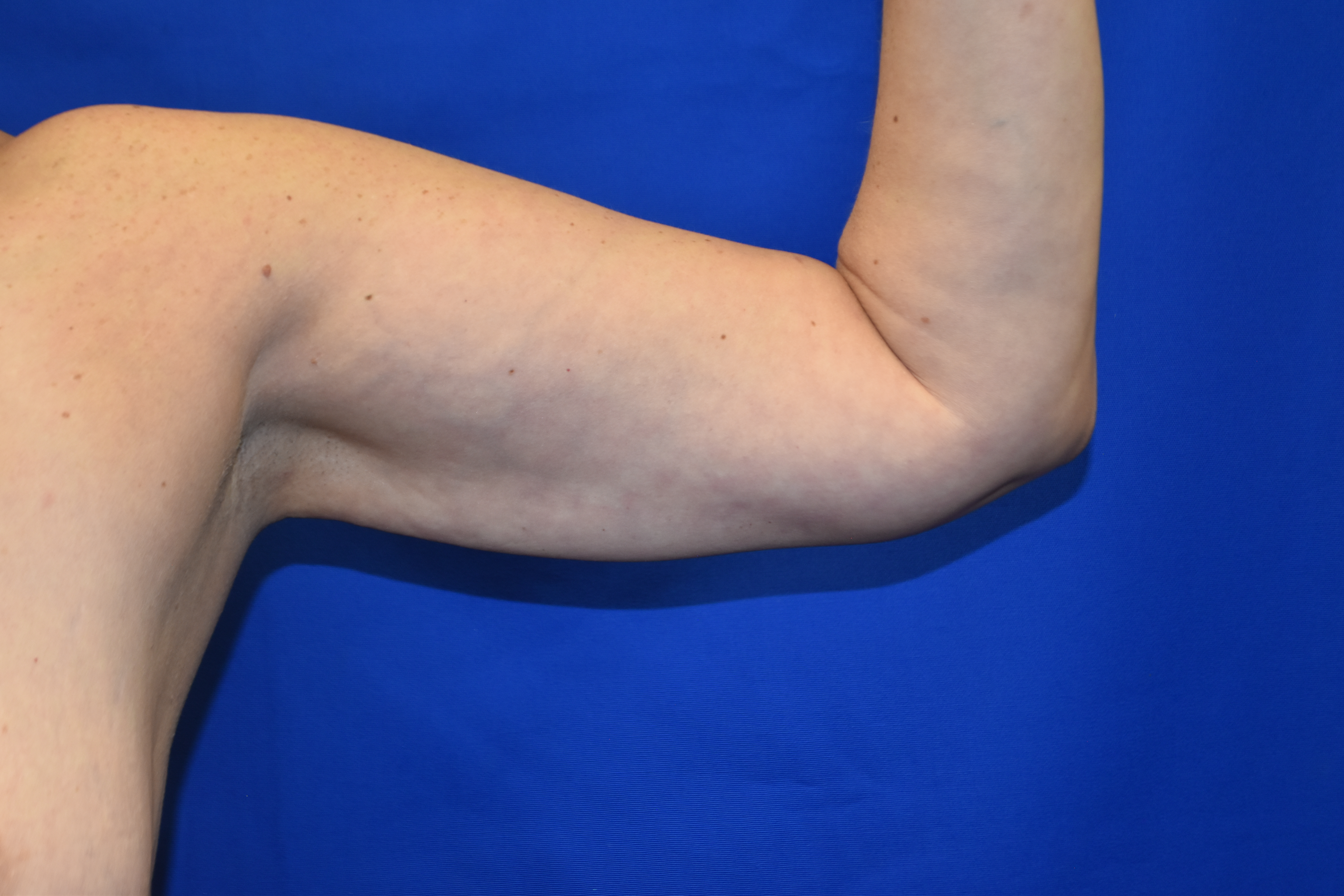 After-Arm Lipo Front