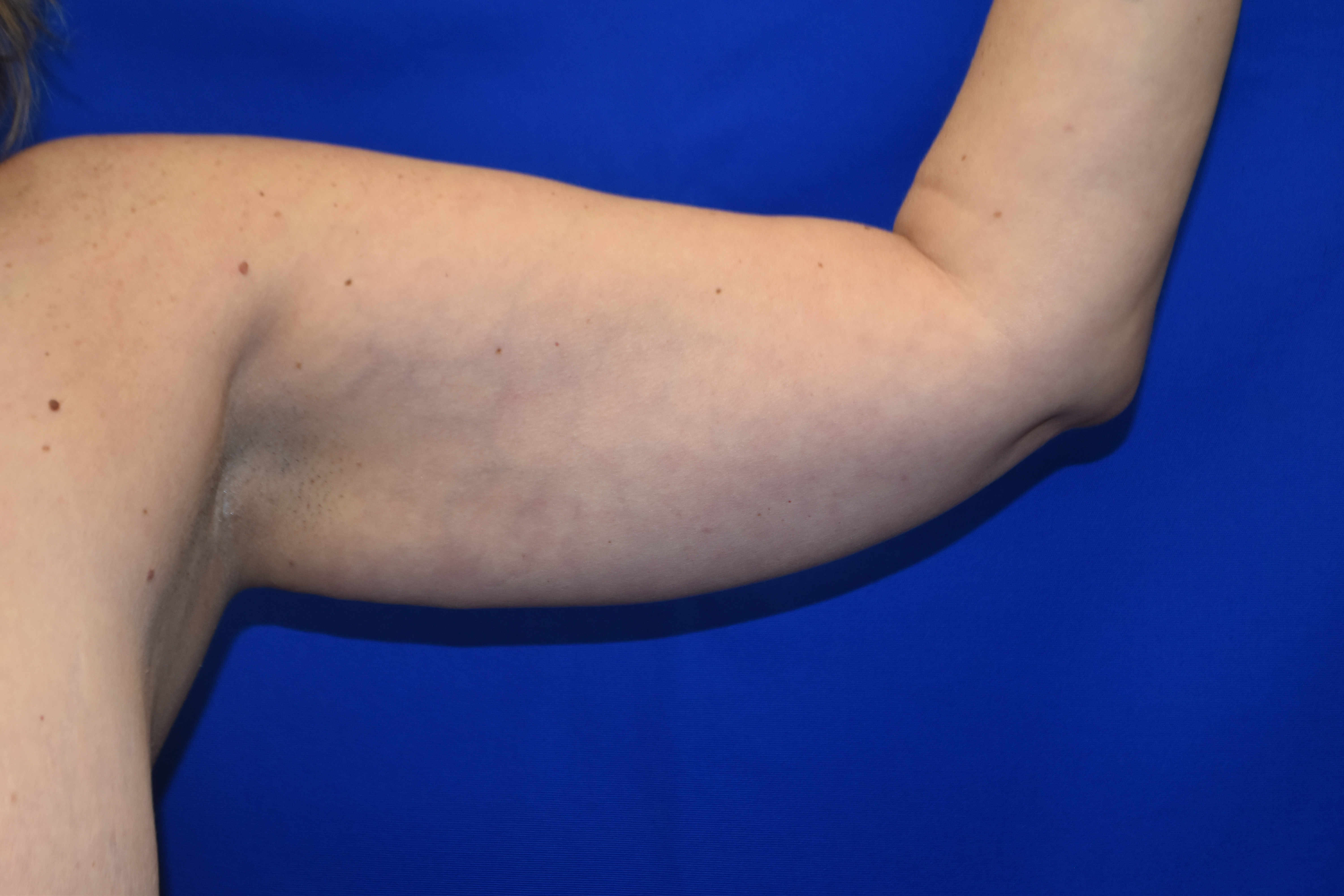 Before-Arm Lipo Front