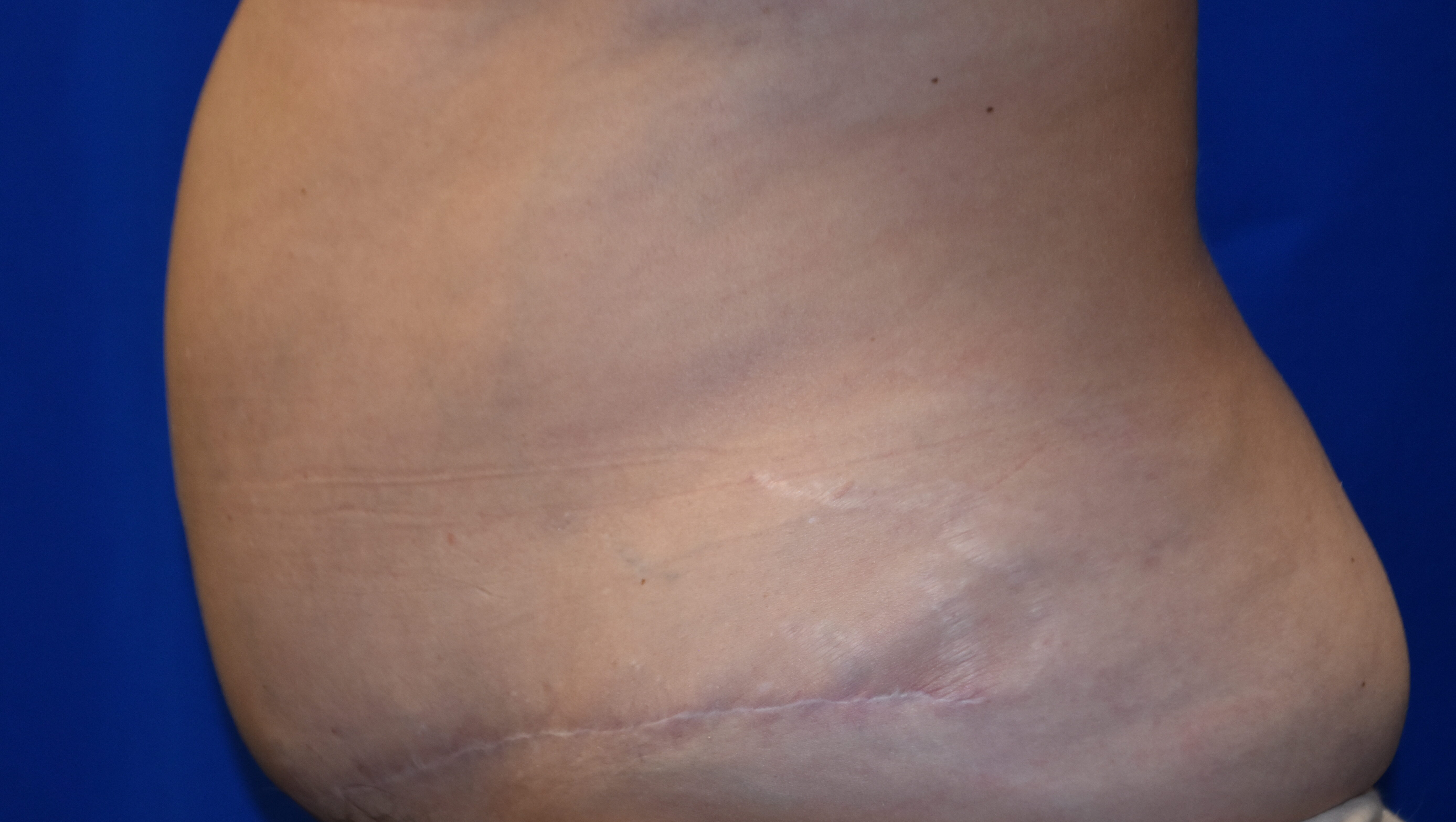 Abdominoplasty (Tummy Tuck), Cincinnati & Springboro
