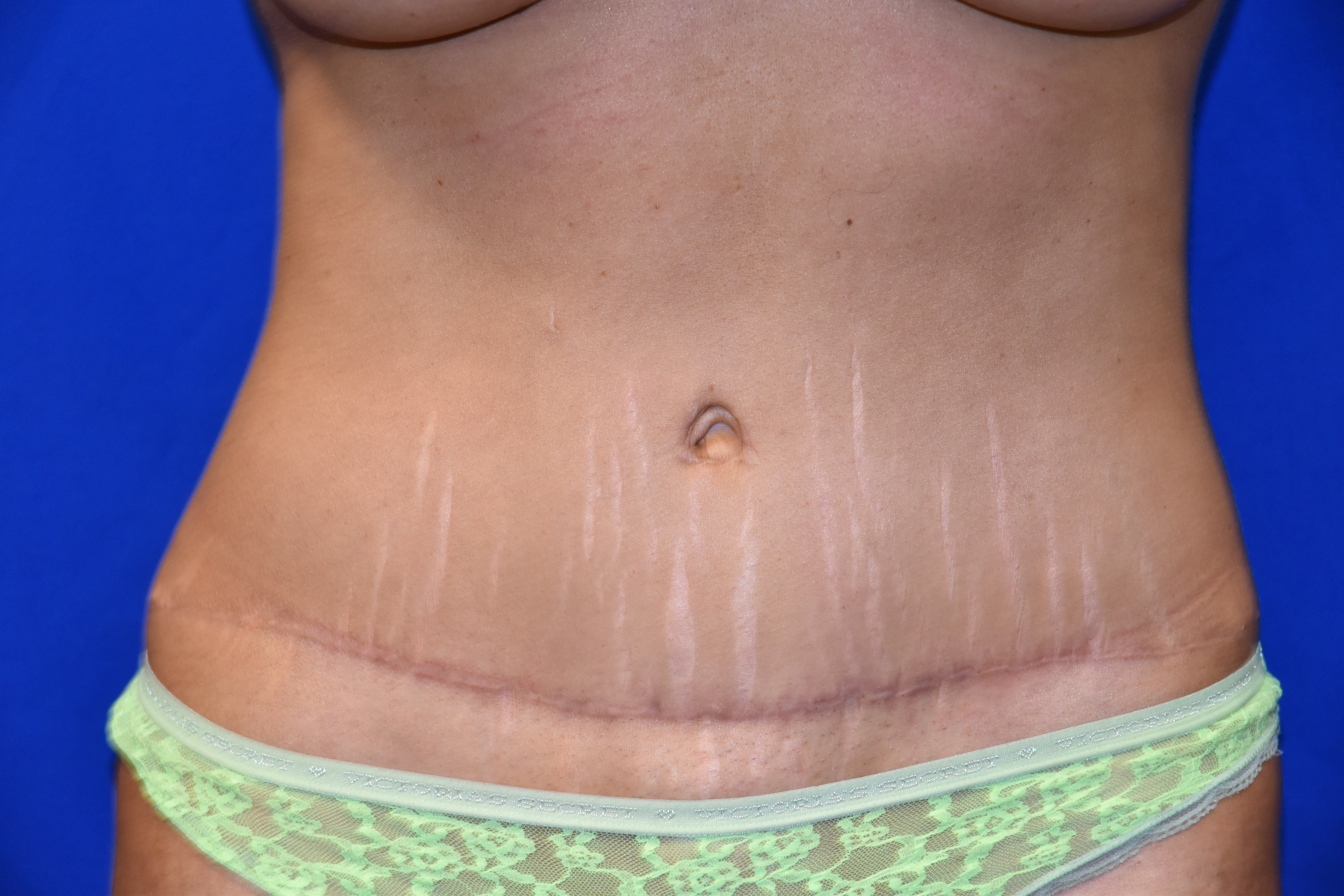 Breast Lift (Mastopexy) - Kurtzman Plastic Surgery